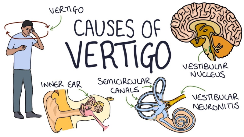 Penyebab Vertigo