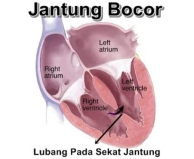 Jantung Bocor