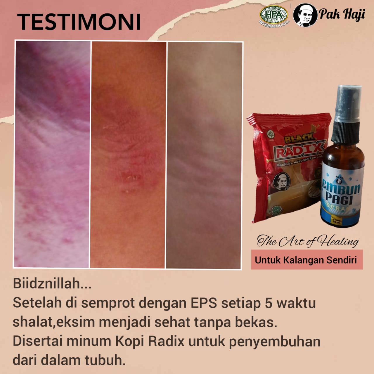 Testimoni Eksim dengan Embun Pagi Spray dan Kopi RADIX