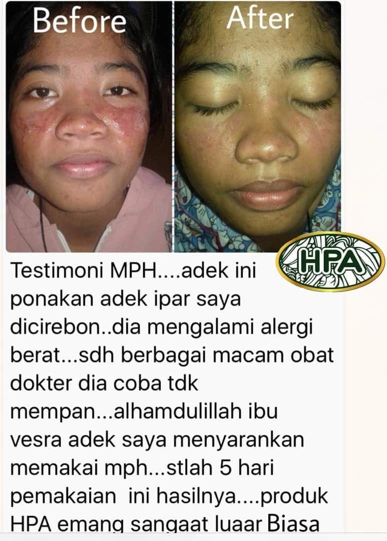 Testimoni MPH untuk Alergi