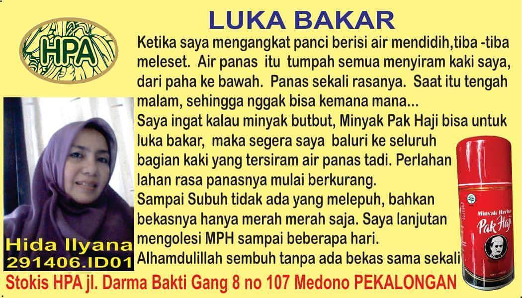 Testimoni MPH untuk Luka Bakar