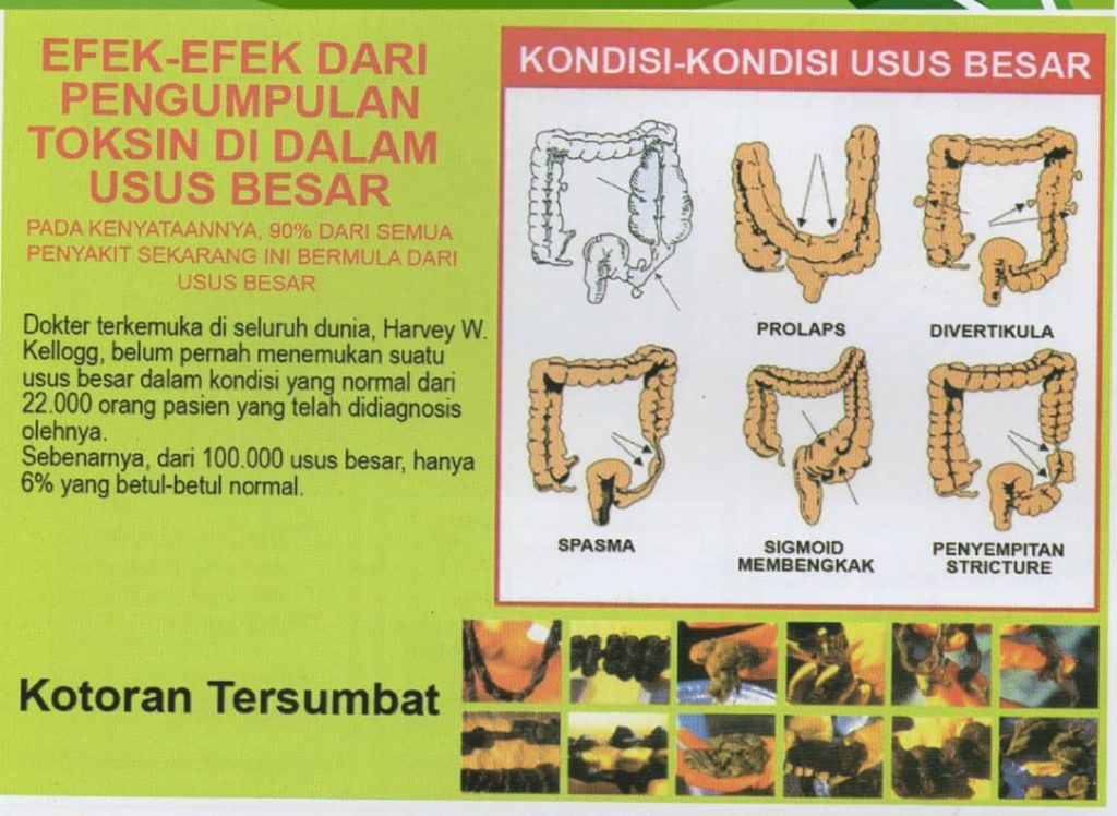 Bagaimana Kotoran Menyumbat Usus