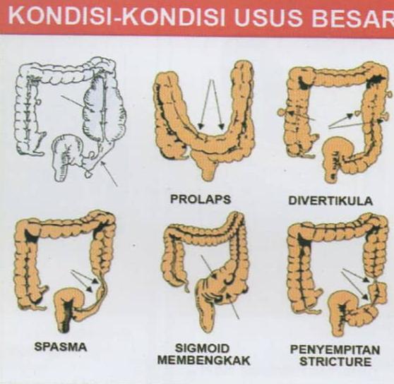 Lima Kondisi Usus yang Bermasalah