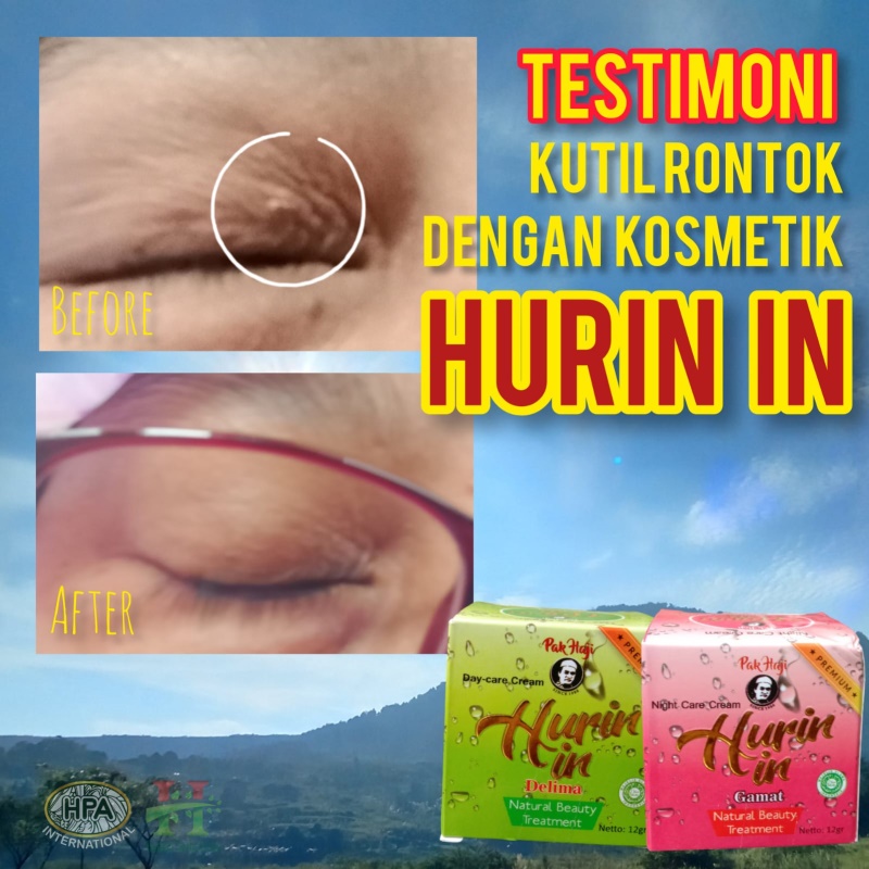 Testimoni Hurin In untuk Kutil