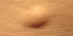 Lipoma