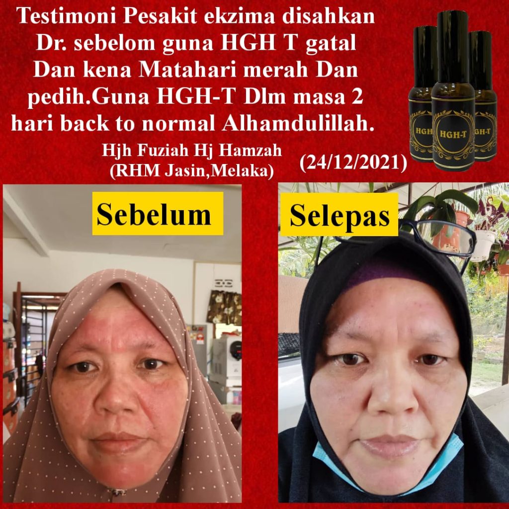 Testimoni Penggunaan HGH-T untuk eksim